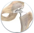 Hip Replacement