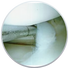 Knee Arthroscopy