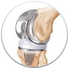 Knee Replacement
