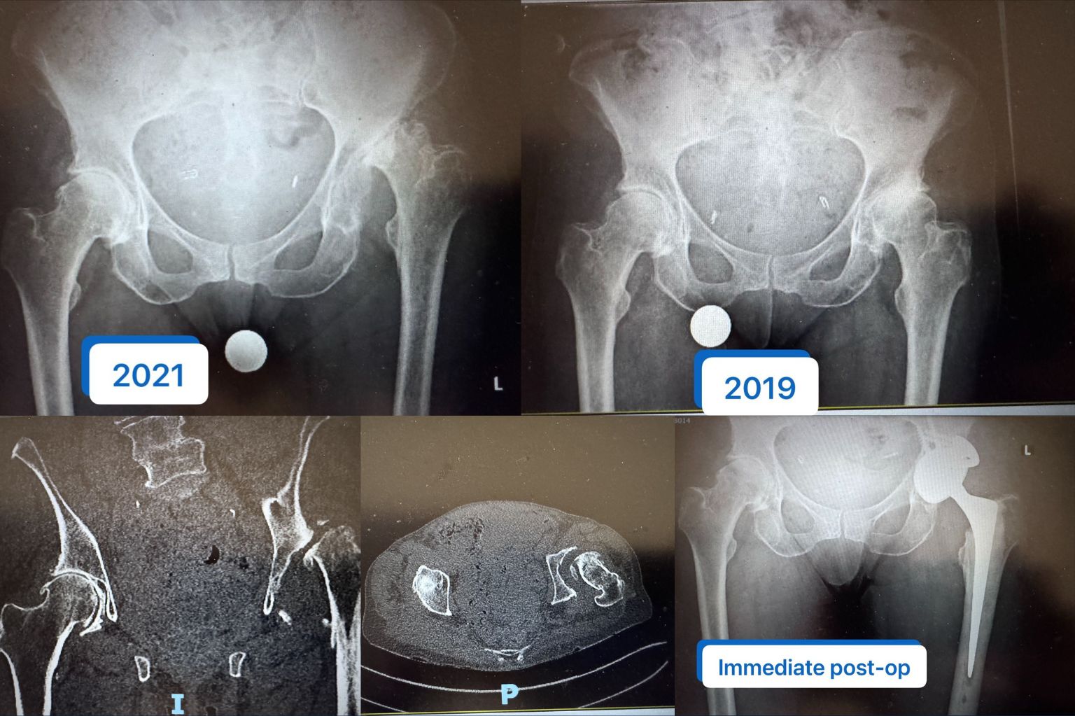 Routine Hip Replacement Turning Complex